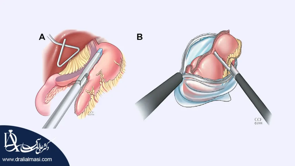 هزینه منگنه های عمل اسلیو معده