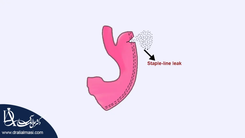 نشت از خط منگنه