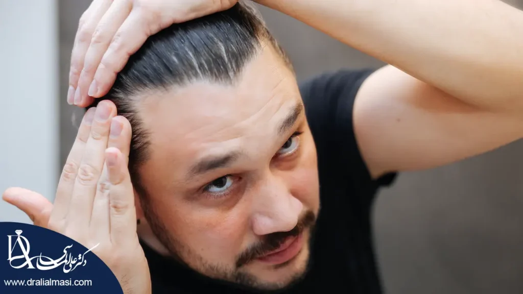 ریزش مو بعد از عمل بای پس معده