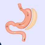 عمل اسلیو معده شاخص