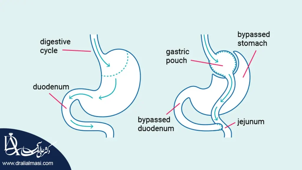 عمل بای پس معده مکانیزم