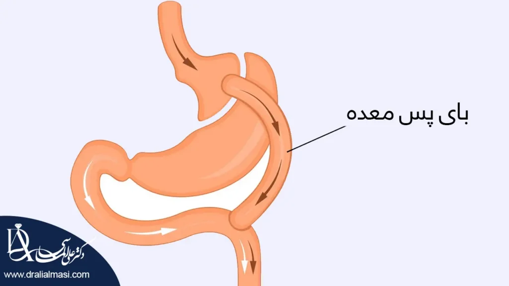 عمل بای پس معده