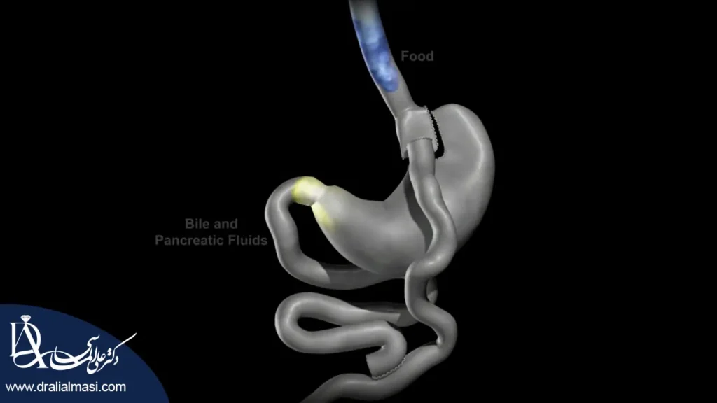 مسیر حرکت غذا بعد از عمل بای پس معده