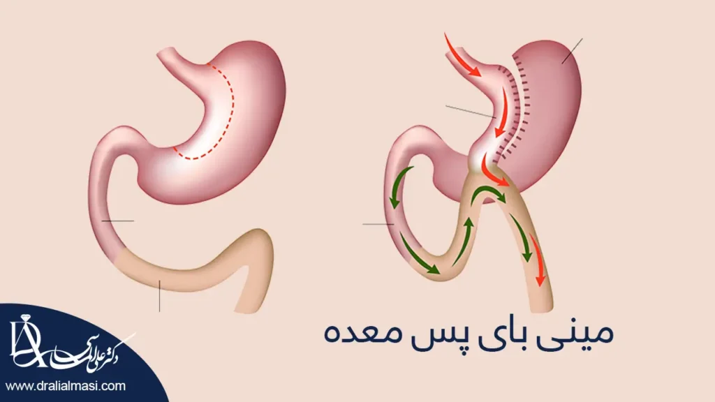 عکس شماتیک مینی بای پس معده