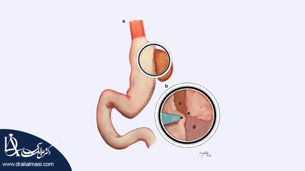 لیکیج یا نشت بعد از عمل اسلیو معده