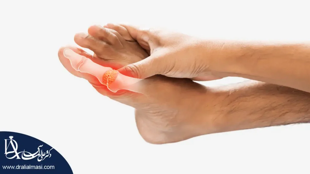 تصویری از آرتروز انگشتان پا