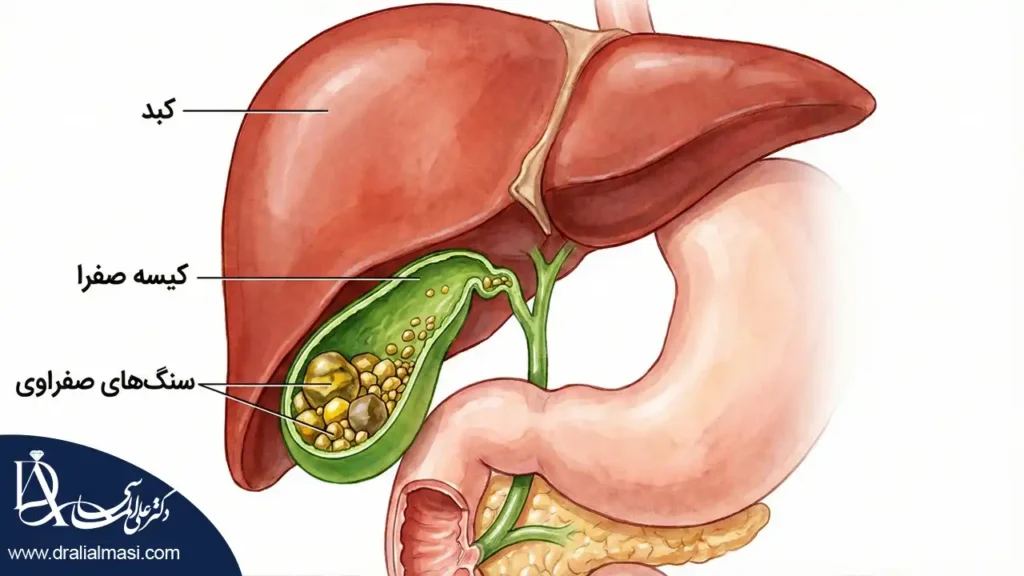 تصویر شماتیک پزشکی نشان‌ دهنده کیسه صفرا حاوی سنگ‌ های متعدد. تشخیص سنگ کیسه صفرا در سونوگرافی قبل از عمل اسلیو بسیار مهم است.