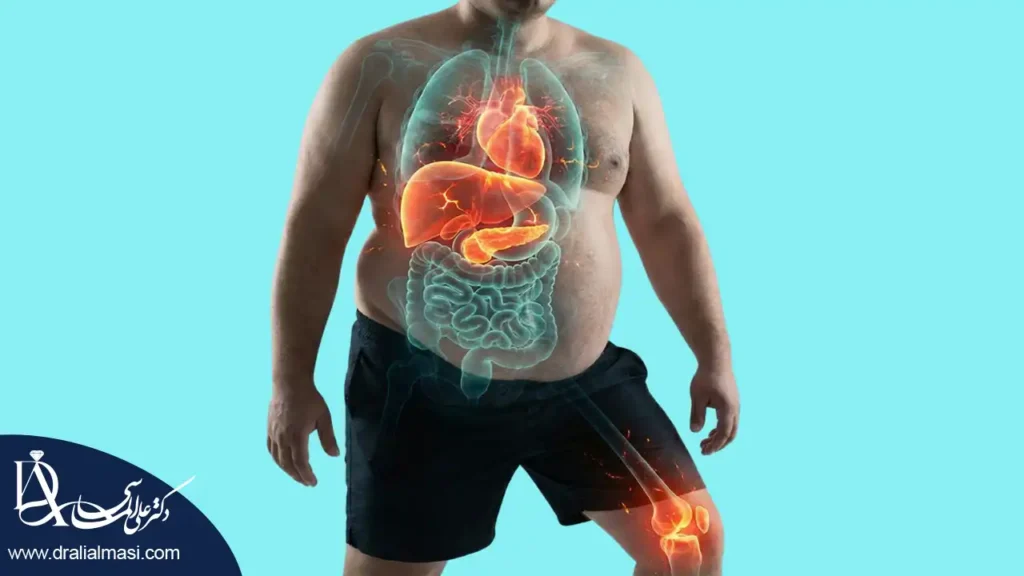 بیماری های مرتبط با چاقی