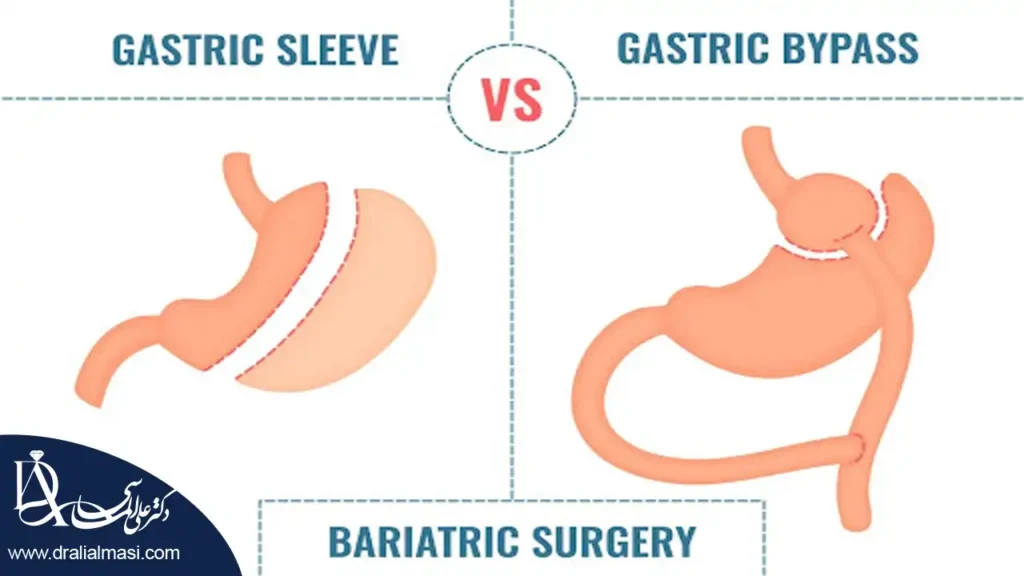 عمل اسلیو معده