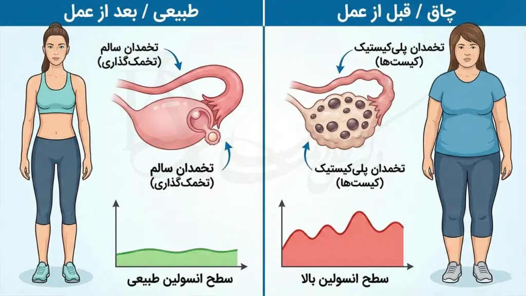 وضعیت کیست تخمدان قبل و بعد از کاهش وزن