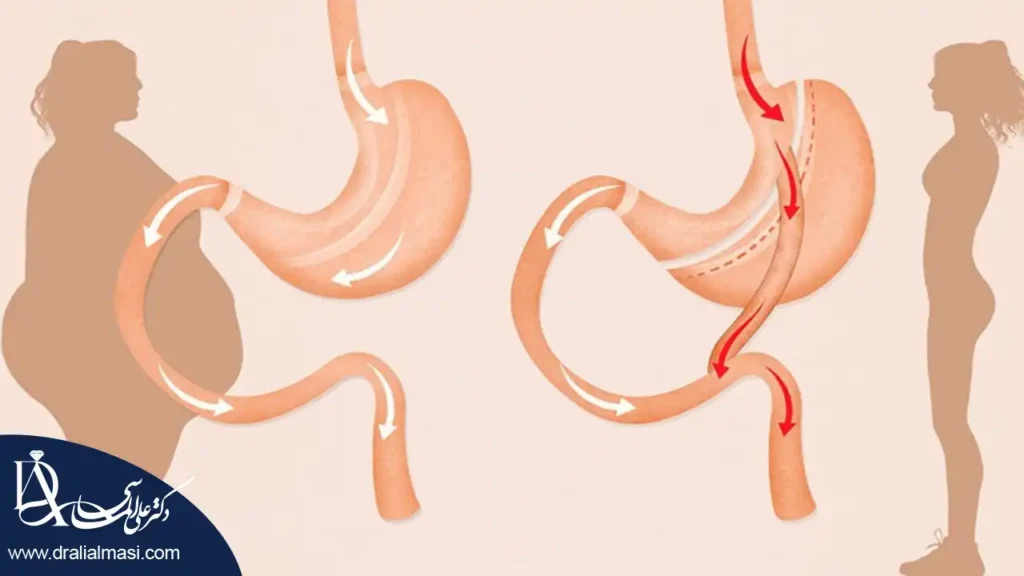 تصویری گرافیکی نشان دهنده تغییرات بعد از عمل اسلیو و بای پس معده