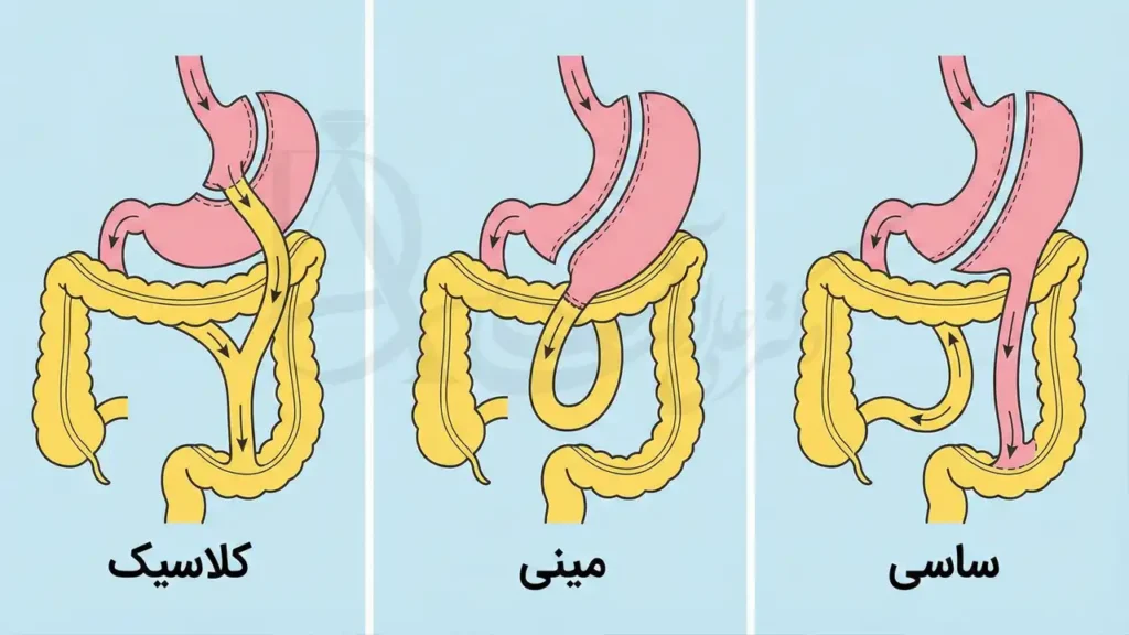 تصویری شماتیک از انواع عمل بای پس معده