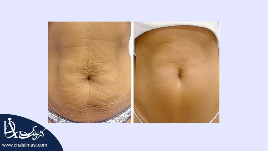 افتادگی پوست بعد از عمل اسلیو معده