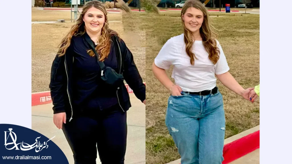 بعد از عمل اسلیو معده در کودکان