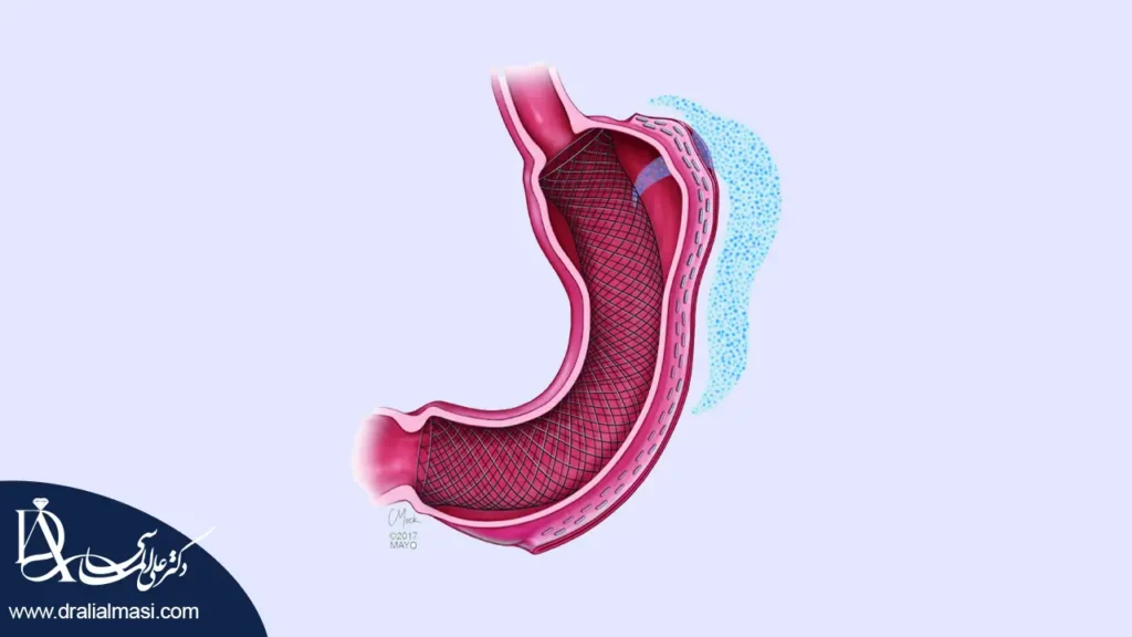 نشتی بعد از عمل اسلیو معده