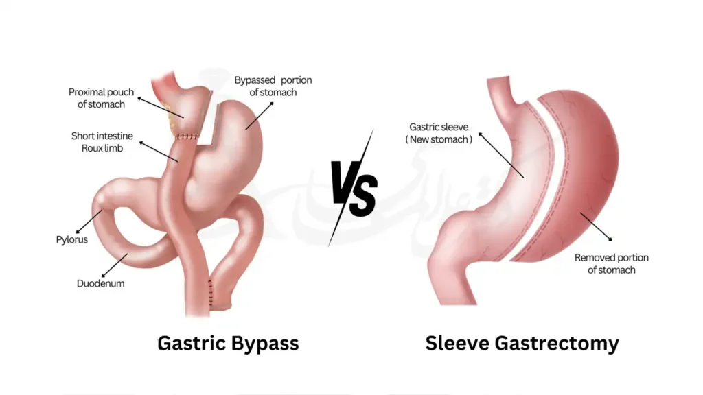 تفاوت اسلیو و بای پس معده