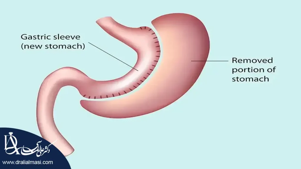 تصویر شماتیک از اسلیو معده