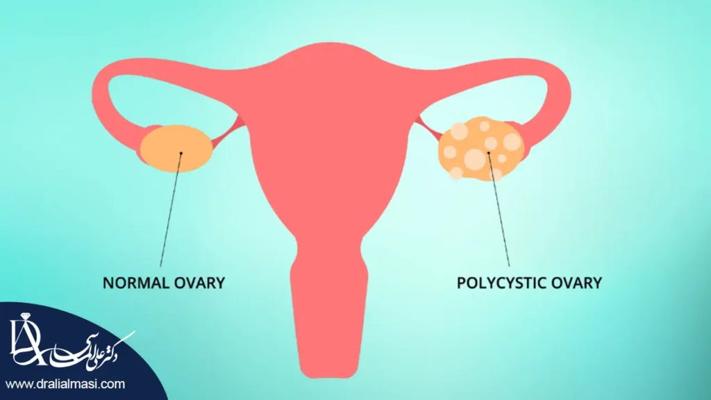 سندروم تخمدان پلی کیستیک