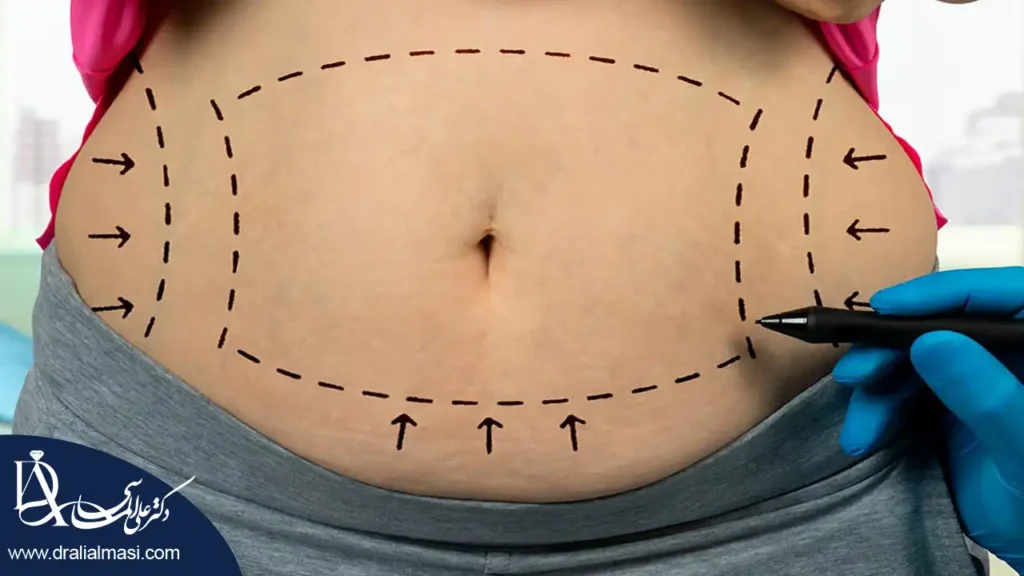 تصویر ابدومینوپلاستی