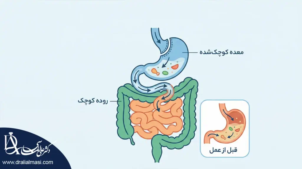 اینفوگرافی نحوه گوارش غذا بعد از عمل لاغری