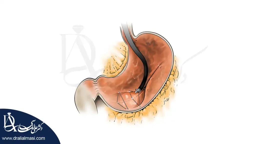 تصویر شماتیک از معده که لوله آندوسکوپی وارد آن شده است