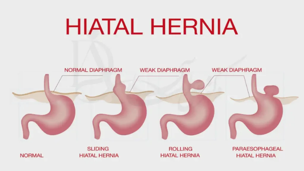 تصویری شماتیک از انواع فتق معده