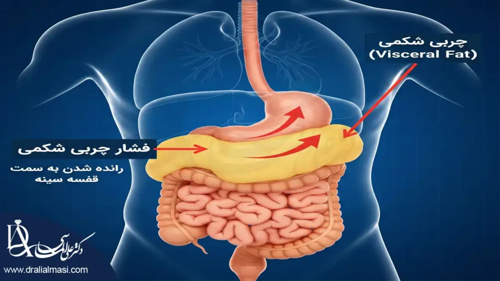 تصویری که نشان میدهد چگونه چربی شکمی باغث فشار به معده شده و آن را به سمت دیافراگم هل می دهد