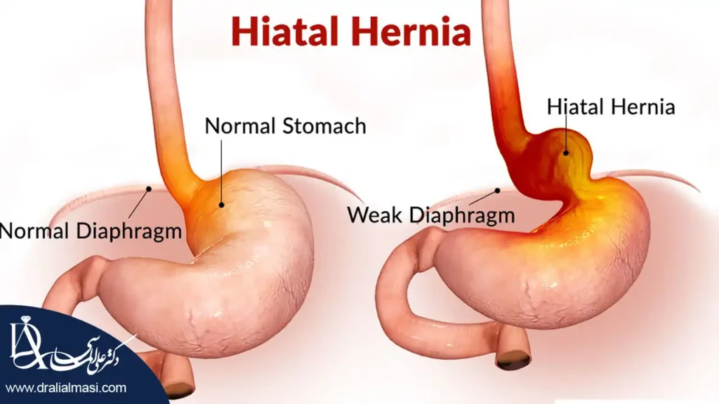 تصویر فتق هیاتال معده