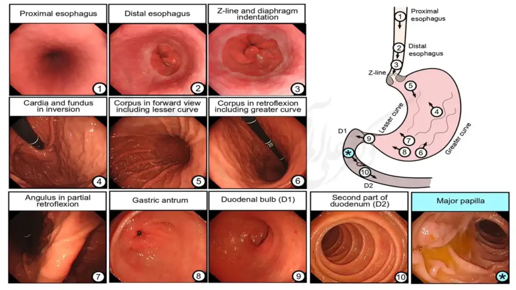 تصویر واقعی از نتایج آندوسکوپی