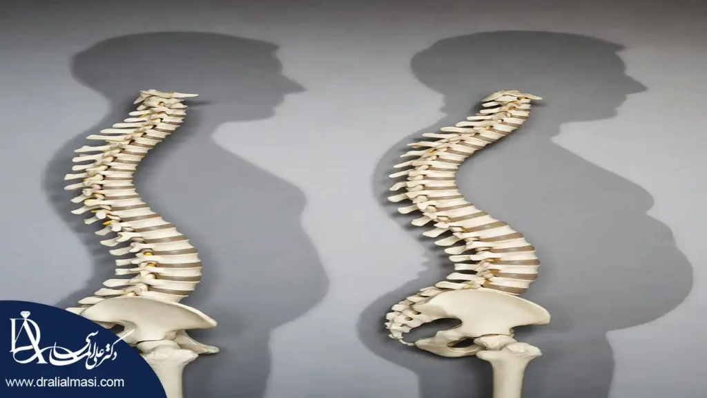تصویری شماتسک از ستون فقرات در بدن یک فرد معمولی و کسی که دارای اضافه وزن هست