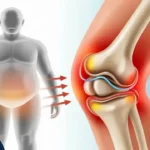 تاثیر چاقی بر زانو درد