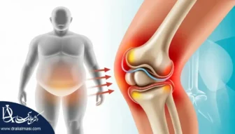 تاثیر چاقی بر زانو درد