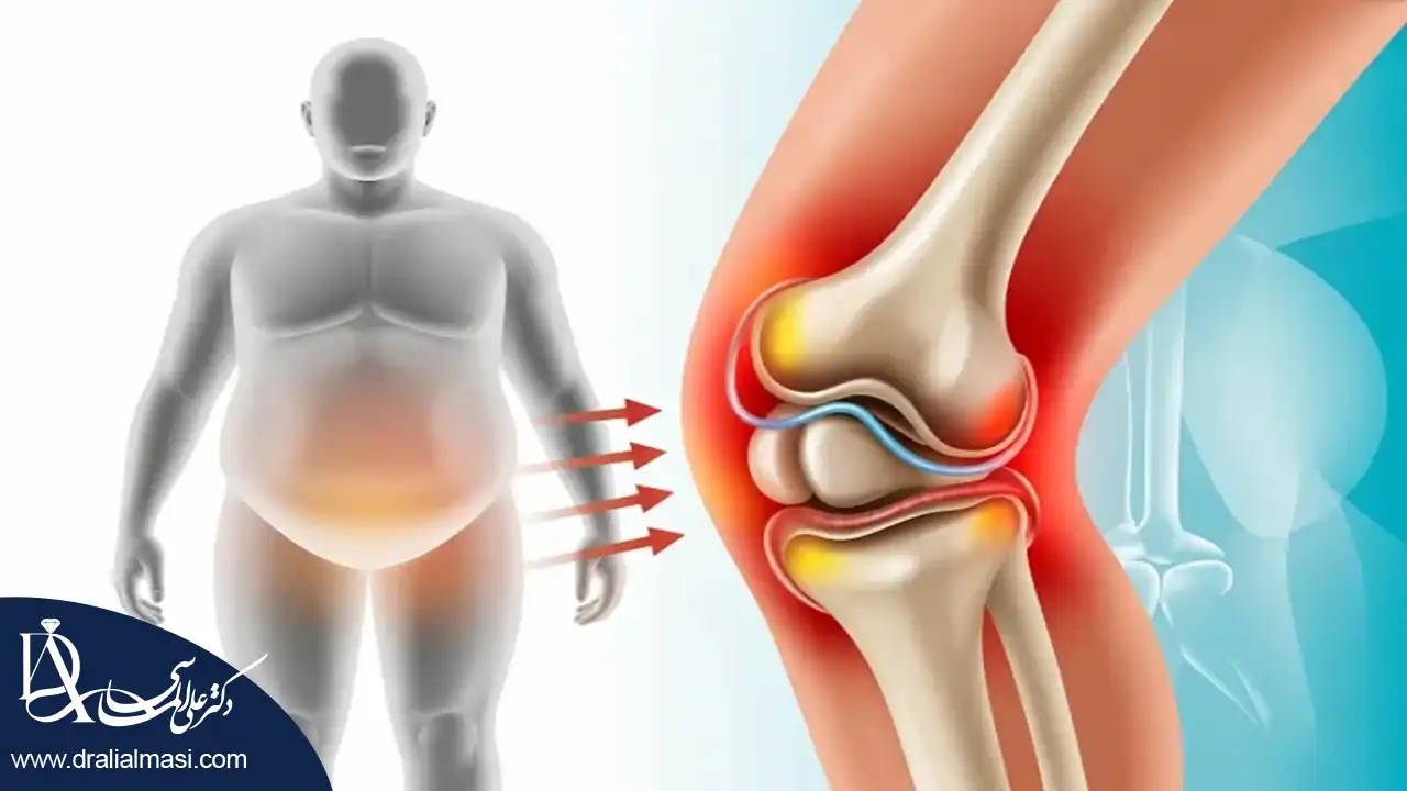 تاثیر چاقی بر زانو درد