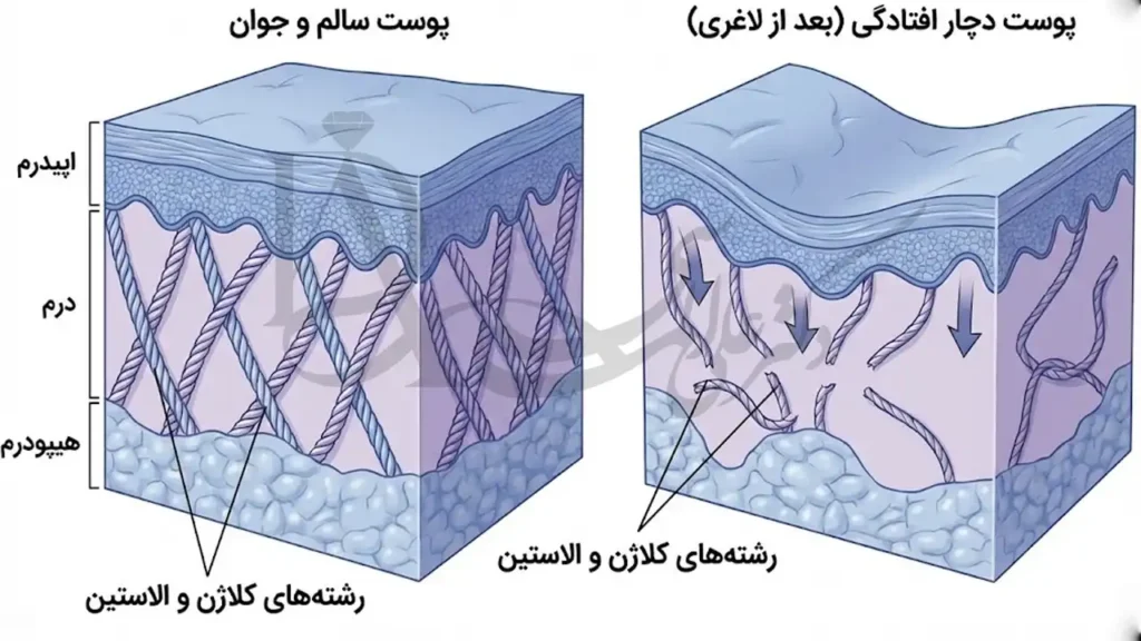 تصویری شماتیم از پوست قبل و بعد از عمل لاغری