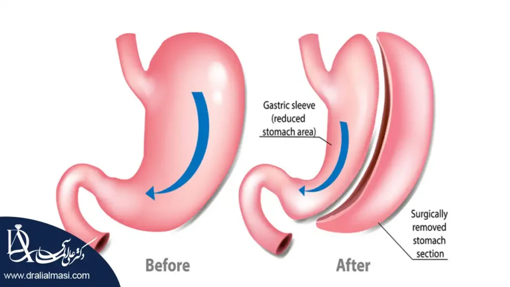 تصویر شماتیک از اسلیو معده