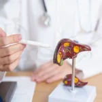 درمان کبد چرب با عمل لاغری