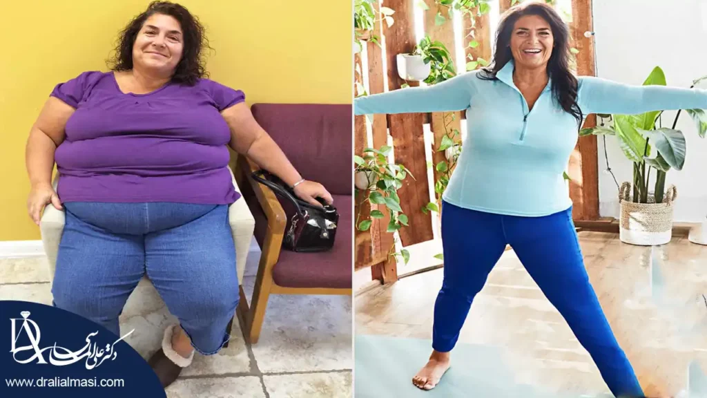 تصویر قبل و بعد عمل لاغری