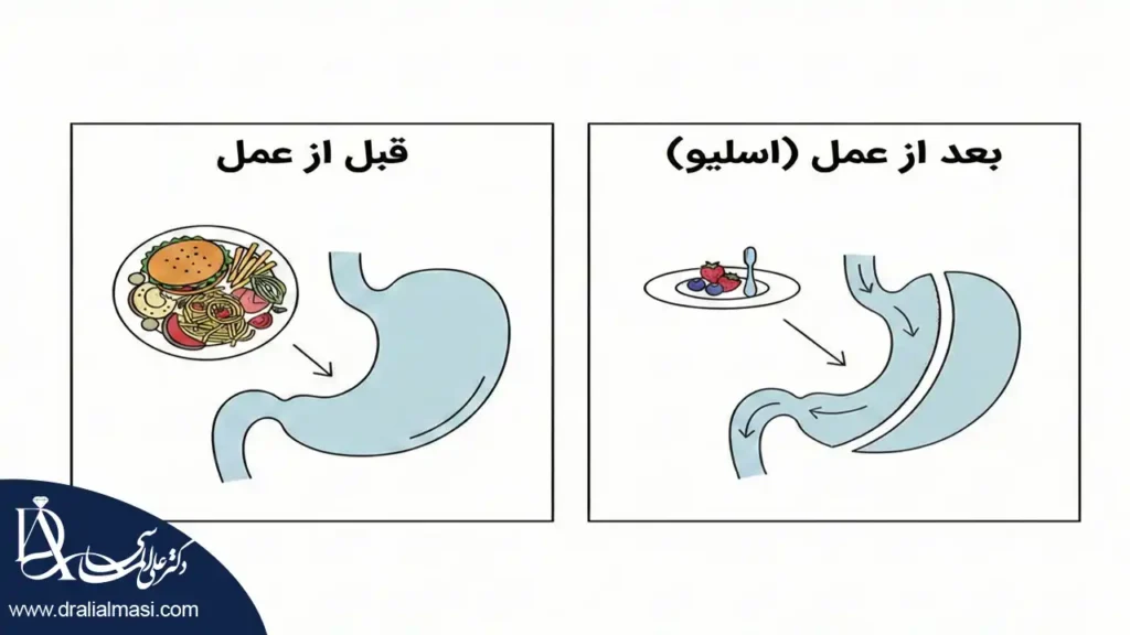 اینفوگرافی درباره حجم غذا قبل از عمل و بعد از عمل اسلیو
