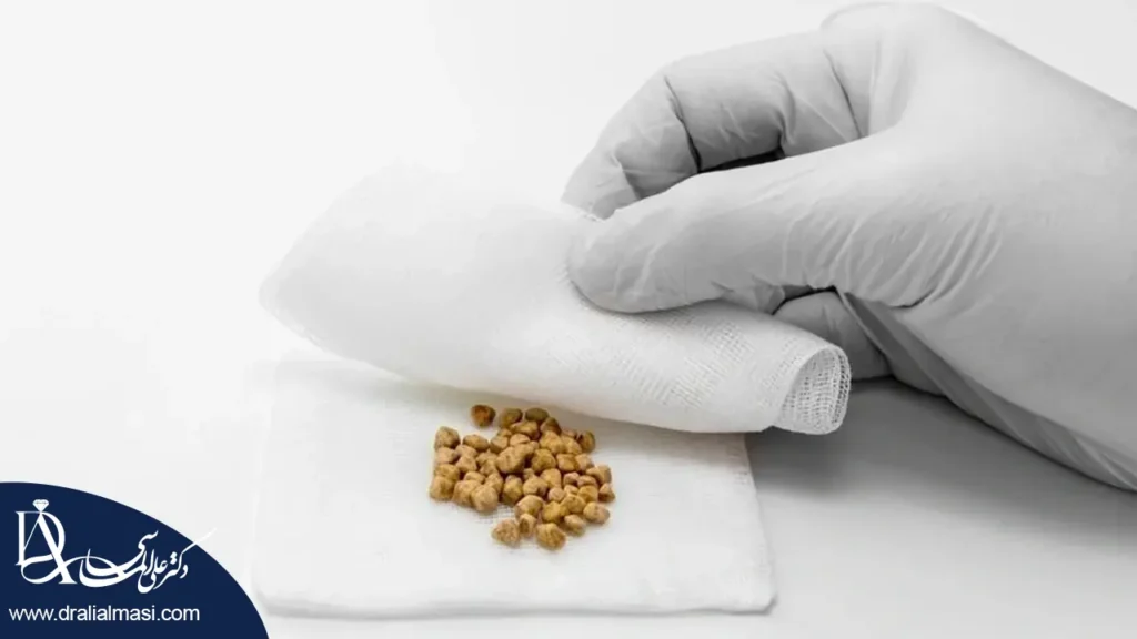 سنگ کیسه صفرا