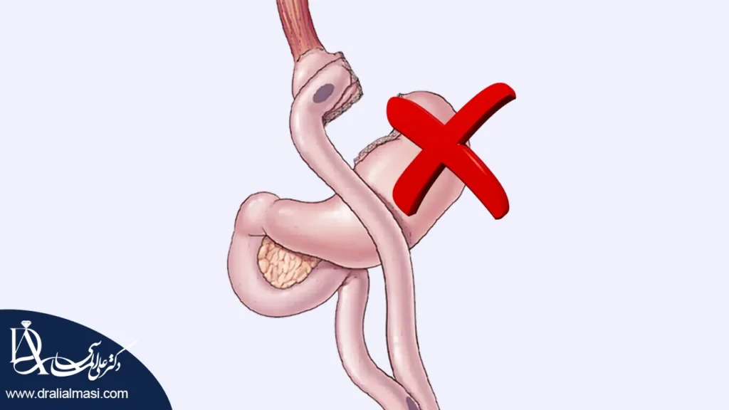 عوارض بای پس معده شاخص