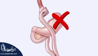 عوارض بای پس معده شاخص