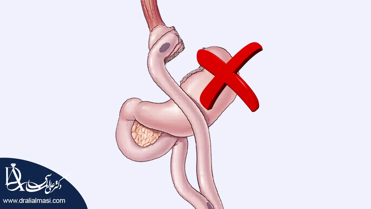 عوارض بای پس معده شاخص