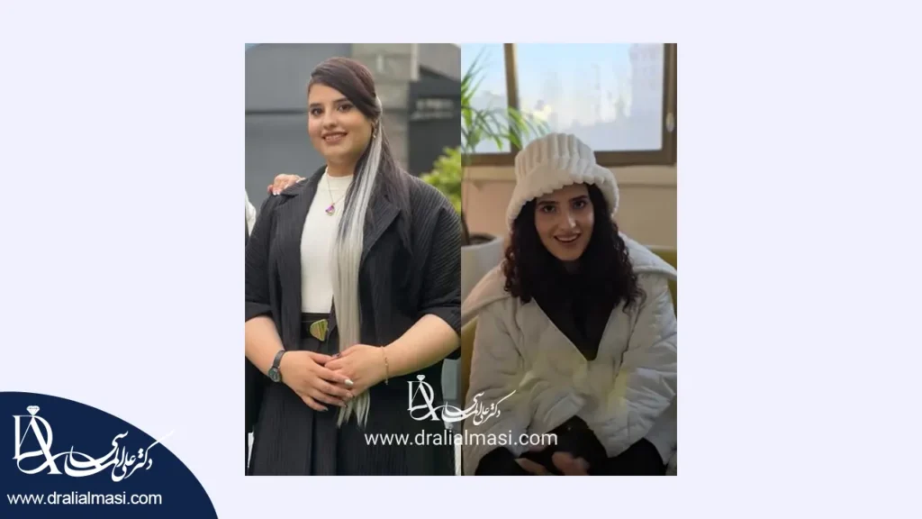 قبل و بعد از عمل لاغری
