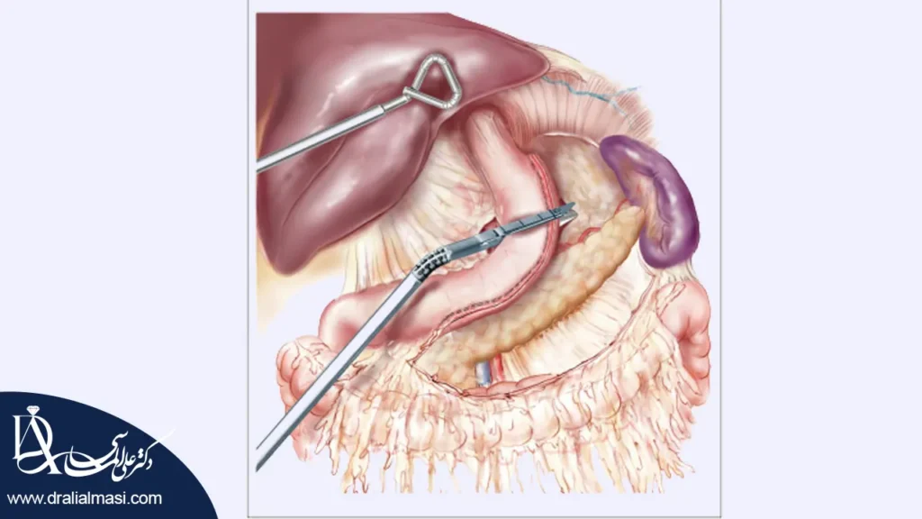 منگنه اسلیو معده چیست شاخص
