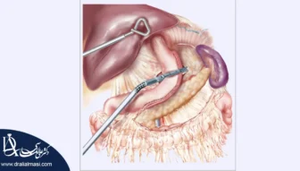 منگنه اسلیو معده چیست شاخص